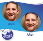Snap On Veneers - Upper and Lower Teeth Cover