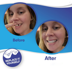 Snap On Veneers - Upper and Lower Teeth Cover