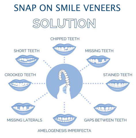 Snap On Veneers - Upper and Lower Teeth Cover